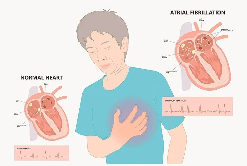 Atrial Fibrillation (AFib): Causes, Symptoms, and New Treatments